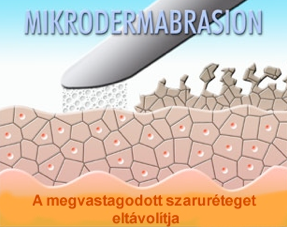 Mikrodermabrázió
